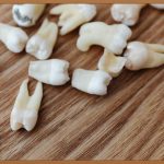 킬본 교정, 숨겨진 매력 파헤치기