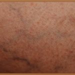 안산 하지정맥류, 꼼꼼하게 따져보고 건강하게 치료받는 방법